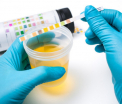 Analiza banala care detecteaza cea mai agresiva forma de cancer. Descoperirea care poate salva mii de vieti