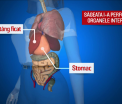 Cazul unei tinere din Romania strapunsa de o sageata in timp ce manca la o terasa i-a uimit pe medici. Cum s-a aparat barbatul care a tras