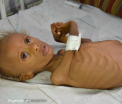 Foamea din Yemen are un chip: Salem are 6 ani si cantareste 4 kilograme. De cand s-a nascut sufera intruna de foame