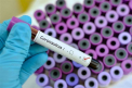 Oamenii cu grupa sanguina A ar fi mai expusi la infectia cu noul coronavirus, arata un studiu preliminar din China
