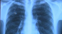 Peste 6,3 milioane de oameni s-ar putea imbolnavi de tuberculoza din cauza pandemiei de coronavirus