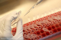 Coronavirus: Cercetatori italieni au descoperit mecanismul ce provoaca raspunsul inflamator la copiii bolnavi de COVID-19