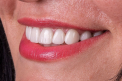 Iti doresti sa ai un zambet ca la Hollywood? Fatetele dentare sunt optiunea perfecta pentru tine. Afla totul despre acestea de la Clinica stomatologica Doctor Romaniuc