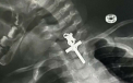 „Este un miracol”. Cum au reusit medicii sa salveze o fetita de zece luni, care a inghitit un crucifix. I s-a blocat in gat - VIDEO