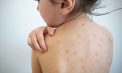 Trei persoane diagnosticate cu rujeolă în Chișinău: doi copii și un adult - VIDEO