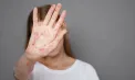 Reapariția rujeolei în Spania. Experții atribuie creșterea cazurilor migranților nevaccinați din Maroc și România