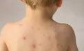 „Persistența febrei înalte, somnolența și convulsiile sunt semne de alarmă”: avertismentul medicilor după moartea unui copil de 5 ani din cauza unei complicații severe a varicelei - VIDEO