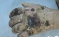 Drogul Krokodil ar fi "lovit" Statele Unite. Arizona este statul de unde s-ar putea raspandi