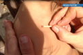 Tot mai multe persoane, intepate de ...capuse! Cum sa procedam atunci cand suntem muscati. Sfaturile medicului - VIDEO