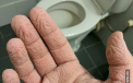 A adormit in cabina de dus. Cum arata mana barbatului dupa ce a stat timp de trei ore in apa