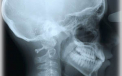 Suferea de dureri grave de cap de zece ani. Ce au descoperit doctorii dupa ce i-au facut o radiografie