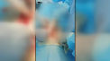 Caz iesit din comun in Kazahstan. Un ghem de par incalcit de trei kilograme si jumatate, a fost scos de catre medici din stomacul unei fetite de 12 ani - VIDEO
