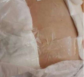 Ancheta la un spital din Rusia, dupa ce medicii au lipit cu scotch o pacienta dupa operatie