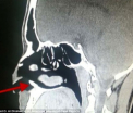 FOTO. A mers la spital din cauza unor probleme nazale. Descoperirea facuta la radiografie i-a surprins si pe medici