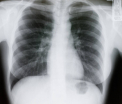 Se plangea de dureri in gat si lesina des. Medicii au inlemnit cand s-au uitat pe radiografie: ce inghitise baiatul. FOTO