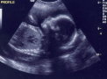 Ce a aratat un bebelus nenascut, in timpul ecografiei. Mama: "Copilul acesta imi va face probleme"