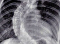 Medicii au fost UIMITI cand au vazut radiografia unei fete de 13 ani. Coloana vertebrala era curbata la 90 de grade