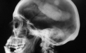 Un barbat a supravietuit miraculos dupa ce o bara din metal de 45 de centimetri i-a strapuns craniul
