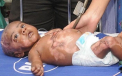 Cazul uimitor al unui bebelus din India care arde singur. Explicatia medicilor: acetona din corp