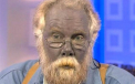 A murit Paul Karason, americanul numit "omul smurf" din cauza pielii sale albastre