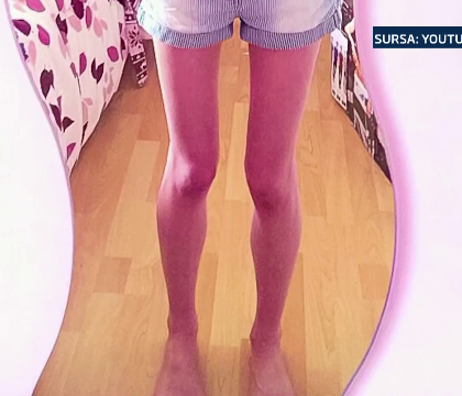"Ma vedeam dezgustator de grasa". Marturiile tulburatoare ale unei tinere de 14 ani, la un pas sa moara de anorexie "Ma vedeam dezgustator de grasa". Marturiile tulburatoare ale unei tinere de 14 ani, la un pas sa moara de anorexie
