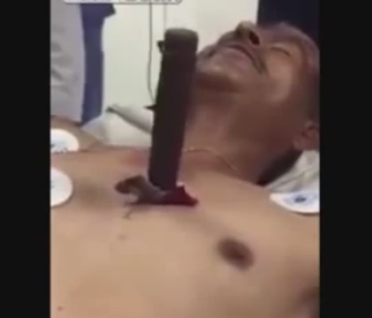 Imagini uluitoare. Un barbat cu un cutit urias infipt in piept vorbeste cu medicii pe patul de spital. VIDEO Imagini uluitoare. Un barbat cu un cutit urias infipt in piept vorbeste cu medicii pe patul de spital. VIDEO