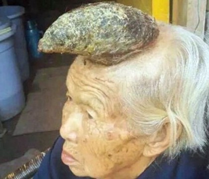 "Femeia-unicorn", misterul medical care i-a bulversat pe doctorii chinezi. Ce i-a aparut pe frunte unei batrane de 87 de ani - VIDEO "Femeia-unicorn", misterul medical care i-a bulversat pe doctorii chinezi. Ce i-a aparut pe frunte unei batrane de 87 de ani - VIDEO