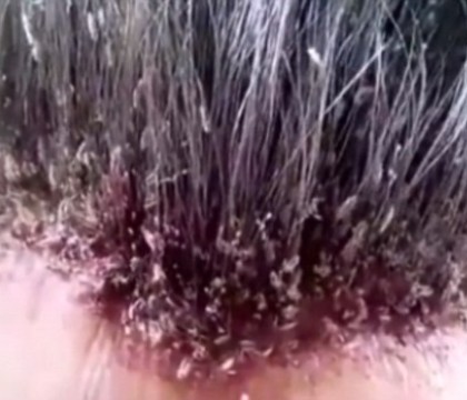 Un video cutremurator face inconjurul internetului. Barbatul cu cel mai grav caz de infestare cu paduchi. VIDEO Un video cutremurator face inconjurul internetului. Barbatul cu cel mai grav caz de infestare cu paduchi. VIDEO