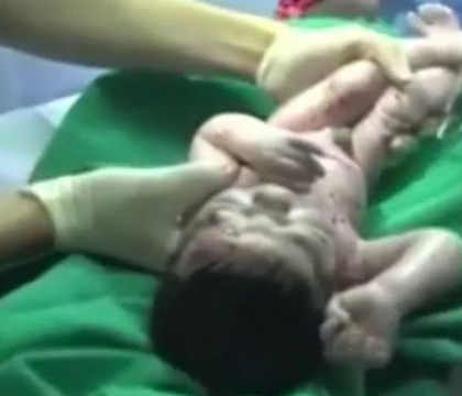 Imagini incredibile. Femeie supusa de urgenta unei cezariene, pentru a-i scoate copilul impuscat in uter. VIDEO