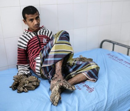 "Omul copac" din Bangladesh a fost operat la maini, dupa o interventie care a durat 3 ore. "Este fericit si a ras" "Omul copac" din Bangladesh a fost operat la maini, dupa o interventie care a durat 3 ore. "Este fericit si a ras"