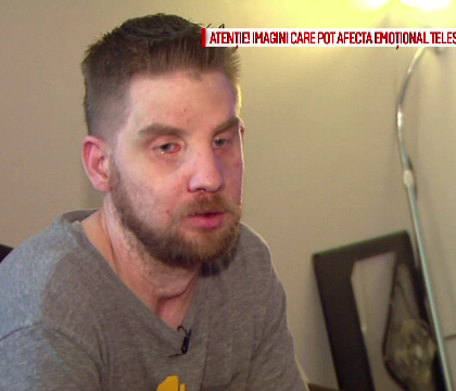 La 5 ani dupa ce a suferit un transplant de fata, un american a povestit prin ce calvar a trecut. "M-a facut mai puternic" La 5 ani dupa ce a suferit un transplant de fata, un american a povestit prin ce calvar a trecut. "M-a facut mai puternic"