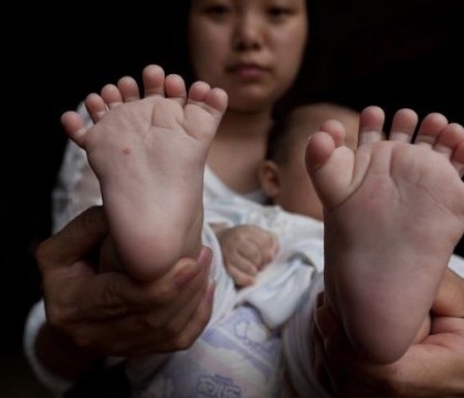 China: un baiat s-a nascut cu 31 de degete la maini si picioare China: un baiat s-a nascut cu 31 de degete la maini si picioare