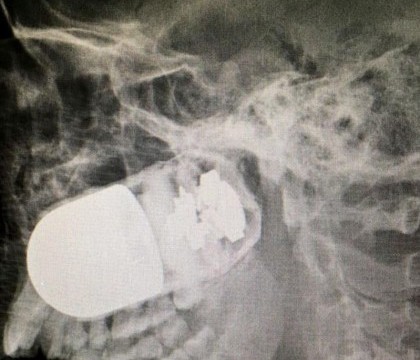 Medicii i-au facut o radiografie unui soldat si declansat imediat alerta. Ce au descoperit cand s-au uitat pe film Medicii i-au facut o radiografie unui soldat si declansat imediat alerta. Ce au descoperit cand s-au uitat pe film