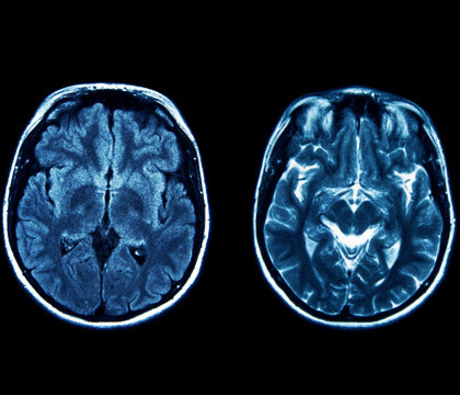 A ajuns la spital cu dureri de cap, iar medicii i-au spus ca mai are de trait 30 de minute. Ce au vazut la tomograf