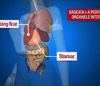 Cazul unei tinere din Romania strapunsa de o sageata in timp ce manca la o terasa i-a uimit pe medici. Cum s-a aparat barbatul care a tras