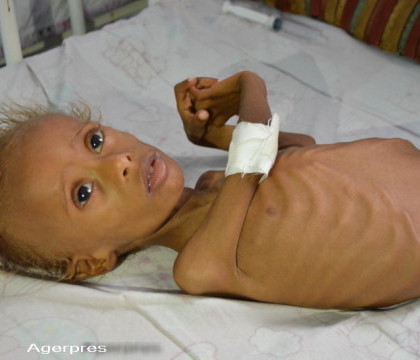 Foamea din Yemen are un chip: Salem are 6 ani si cantareste 4 kilograme. De cand s-a nascut sufera intruna de foame