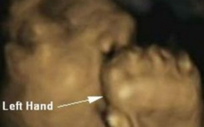 Imagini uimitoare surprinse la ecograf. Ce au vazut medicii cand s-au uitat la acesti bebelusi Imagini uimitoare surprinse la ecograf. Ce au vazut medicii cand s-au uitat la acesti bebelusi