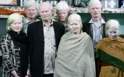 Una dintre cele mai celebre familii din India. Toti cei opt membri sufera de albinism. VIDEO Una dintre cele mai celebre familii din India. Toti cei opt membri sufera de albinism. VIDEO