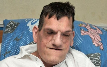"Omul elefant." Un tanar englez a suferit 74 de operatii si nu a mai iesit din casa in ultimii ani