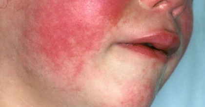 Atentie parinti. Mai multi copii, care merg la gradinitele din capitala, diagnosticati cu scarlatina si internati in Spitalul Clinic de Boli Infectioase Atentie parinti. Mai multi copii, care merg la gradinitele din capitala, diagnosticati cu scarlatina si internati in Spitalul Clinic de Boli Infectioase