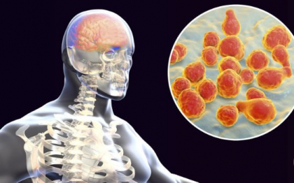 Autoritatile medicale sunt in alerta. In Romania a aparut un al treilea caz de meningita meningococica Autoritatile medicale sunt in alerta. In Romania a aparut un al treilea caz de meningita meningococica