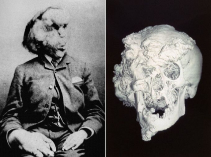 Mormantul „Omului Elefant”, descoperit de o scriitoare. In ce oras a fost inmormantat Mormantul „Omului Elefant”, descoperit de o scriitoare. In ce oras a fost inmormantat