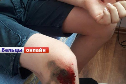 O haita de caini a atacat un copil de 12 ani la Balti. Acesta nu este primul caz. Mama copilului cere sa fie luate masuri