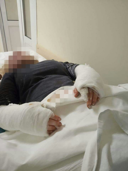 Doua minore, atacate bestial de un caine la Ialoveni. Una dintre ele e in stare grava la spital Doua minore, atacate bestial de un caine la Ialoveni. Una dintre ele e in stare grava la spital