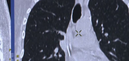 Boala grava care se transmite usor in mijloacele de transport in comun. Care sunt simptomele Boala grava care se transmite usor in mijloacele de transport in comun. Care sunt simptomele