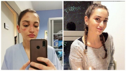 Asistenta din "zona-zero" a Italiei, cu rani pe fata cauzate de mastile chirurgicale. Mesajul emotionant transmis de ea catre cei din afara spitalului: "Mi-e teama" - FOTO