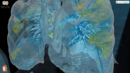 Un medic american explica cum ne afecteaza organismul Covid-19. „O vatamare extinsa a plamanului” Un medic american explica cum ne afecteaza organismul Covid-19. „O vatamare extinsa a plamanului”