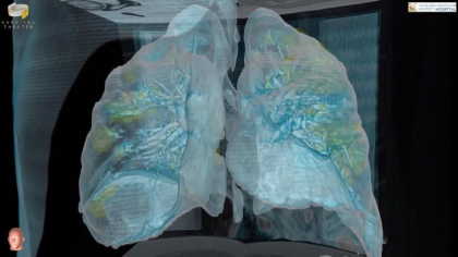 Cum arata plamanii unui pacient bolnav de COVID-19. Imagini 3D cu leziunile produse de coronavirus. „Oamenii sa ia asta in serios” Cum arata plamanii unui pacient bolnav de COVID-19. Imagini 3D cu leziunile produse de coronavirus. „Oamenii sa ia asta in serios”