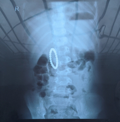 Un copil din capitala, salvat de medici dupa ce a inghitit o jucarie cu bile magnetice - FOTO