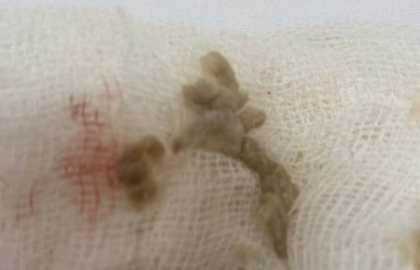 Un bebelus - operat de urgenta in capitala, dupa ce a inghitit o bucata de hartie. Ce spun medicii - FOTO Un bebelus - operat de urgenta in capitala, dupa ce a inghitit o bucata de hartie. Ce spun medicii - FOTO